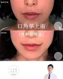 口角挙上 before画像 サムネイル用