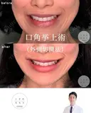 口角挙上 after画像 サムネイル用
