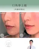 口角挙上 after画像 サムネイル用