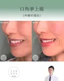 口角挙上 after画像 サムネイル用