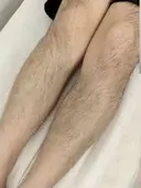 医療脱毛 before画像 サムネイル用