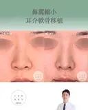 鼻翼縮小＋耳介軟骨移植 after画像 サムネイル用