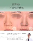 鼻翼縮小＋耳介軟骨移植 after画像 サムネイル用