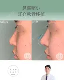 鼻翼縮小＋耳介軟骨移植 after画像 サムネイル用
