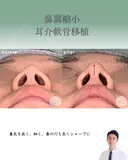 鼻翼縮小＋耳介軟骨移植 after画像 サムネイル用