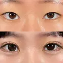 二重整形－埋没法－ before画像 サムネイル用