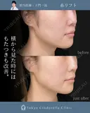 クイックリフト８本 before画像 サムネイル用