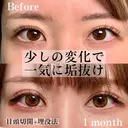 埋没＋目頭切開 before画像 サムネイル用