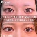 自然癒着法＋目頭切開＋目の上脱脂 90日後 サムネイル用