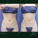 しっかり薄くなり、くびれも綺麗に出来ています✨ 60日後 サムネイル用