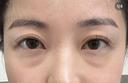 医療ハイフ　300ショット目周り before画像 サムネイル用