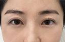 医療ハイフ　300ショット目周り after画像 サムネイル用