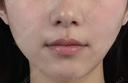 医療ハイフ　部分300ショット after画像 サムネイル用