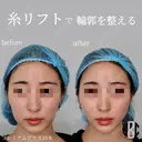 糸リフト after画像 サムネイル用