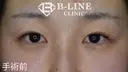 【切開法二重術】1ヵ月後 before画像 サムネイル用