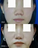 鼻尖縮小＋鼻翼縮小（外側法） after画像 サムネイル用