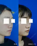 鼻尖縮小＋鼻翼縮小（外側法） after画像 サムネイル用