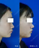 鼻尖縮小＋鼻翼縮小（外側法） after画像 サムネイル用