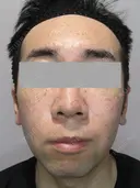 IPL治療(アキュライト・アキュプラス) before画像 サムネイル用