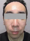 IPL治療(アキュライト・アキュプラス) after画像 サムネイル用