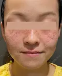 IPL治療(アキュライト・アキュプラス) before画像 サムネイル用