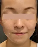 IPL治療(アキュライト・アキュプラス) after画像 サムネイル用