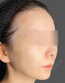 唇のヒアルロン酸注入 before画像 サムネイル用