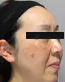 ピコトーニング before画像 サムネイル用
