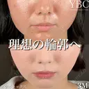 【🍫エラボトックス🍫】 before画像 サムネイル用