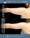 アキーセル脂肪吸引(二の腕全周) before画像 サムネイル用