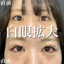 白目拡大（目尻切開＋タレ目形成） before画像 サムネイル用