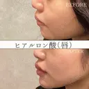 唇ヒアルロン酸 注入術 before画像 サムネイル用