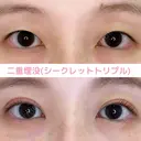 二重埋没 after画像 サムネイル用