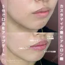 ヒアルロン酸 before画像 サムネイル用