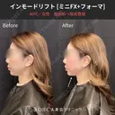 インモードリフト（miniFX・Forma）1回 0日後 サムネイル用