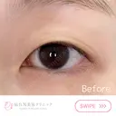 二重埋没 before画像 サムネイル用