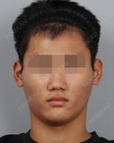 輪郭１点（３D頬骨縮小） before画像 サムネイル用