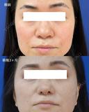 鼻尖縮小＋鼻翼縮小(外側法) after画像 サムネイル用