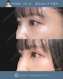 切らないクマ取り before画像 サムネイル用