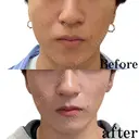 エラボトックス before画像 サムネイル用