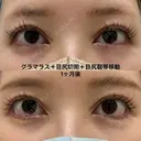 たれ目形成、滑らかなS字デザイン after画像 サムネイル用