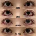 たれ目形成、滑らかなS字デザイン after画像 サムネイル用