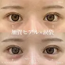 加賀ヒアル×涙袋 before画像 サムネイル用