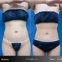 韓国風くびれGET💪✨ before画像 サムネイル用
