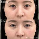クマ消し(目の下)ヒアルロン酸 after画像 サムネイル用