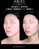 鼻孔縁挙上/鼻尖形成/ 小鼻縮小/鼻翼軟骨トリム/鼻翼挙上 before画像 サムネイル用
