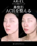 鼻孔縁挙上/鼻尖形成/ 小鼻縮小/鼻翼軟骨トリム/鼻翼挙上 120日後 サムネイル用