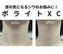 アラガン社製ボライトXC 30日後 サムネイル用