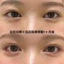 目尻切開＋目尻靱帯移動 before画像 サムネイル用