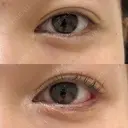 目尻切開＋目尻靱帯移動 after画像 サムネイル用